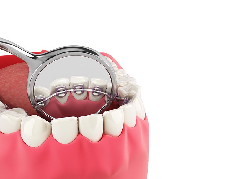 Orthodontics – Braces