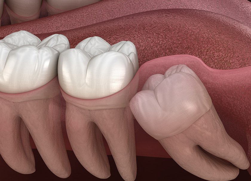 Wisdom Tooth Third Molar Disimpaction